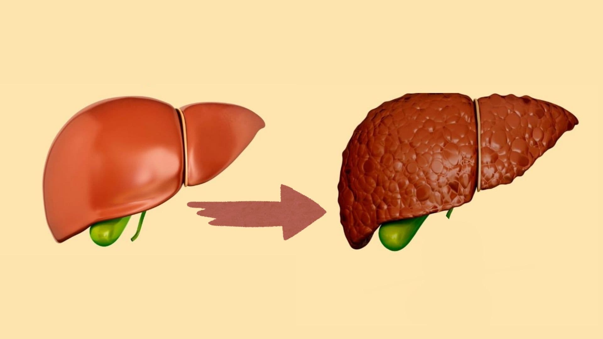 Non-Alkolik Yağlı Karaciğer Hastalığında Beslenme Rehberi