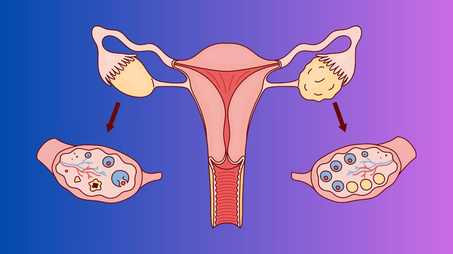 Sessiz Bir Misafir: Polikistik Over Sendromu (PKOS) ve Beslenme Önerileri